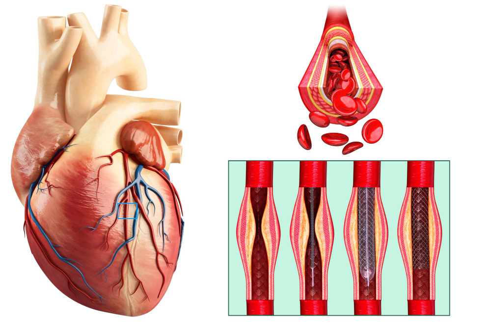 Coronary Angioplasty and Stenting