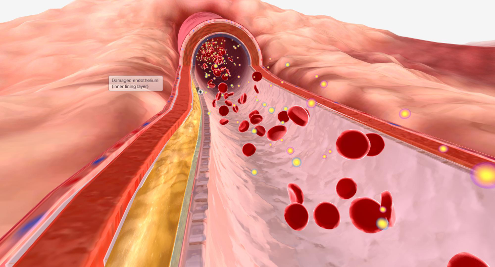 Lipid Disorders (Hyperlipidemia)